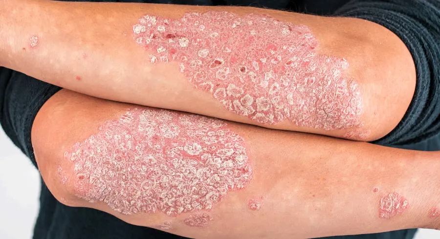 Psoriasis