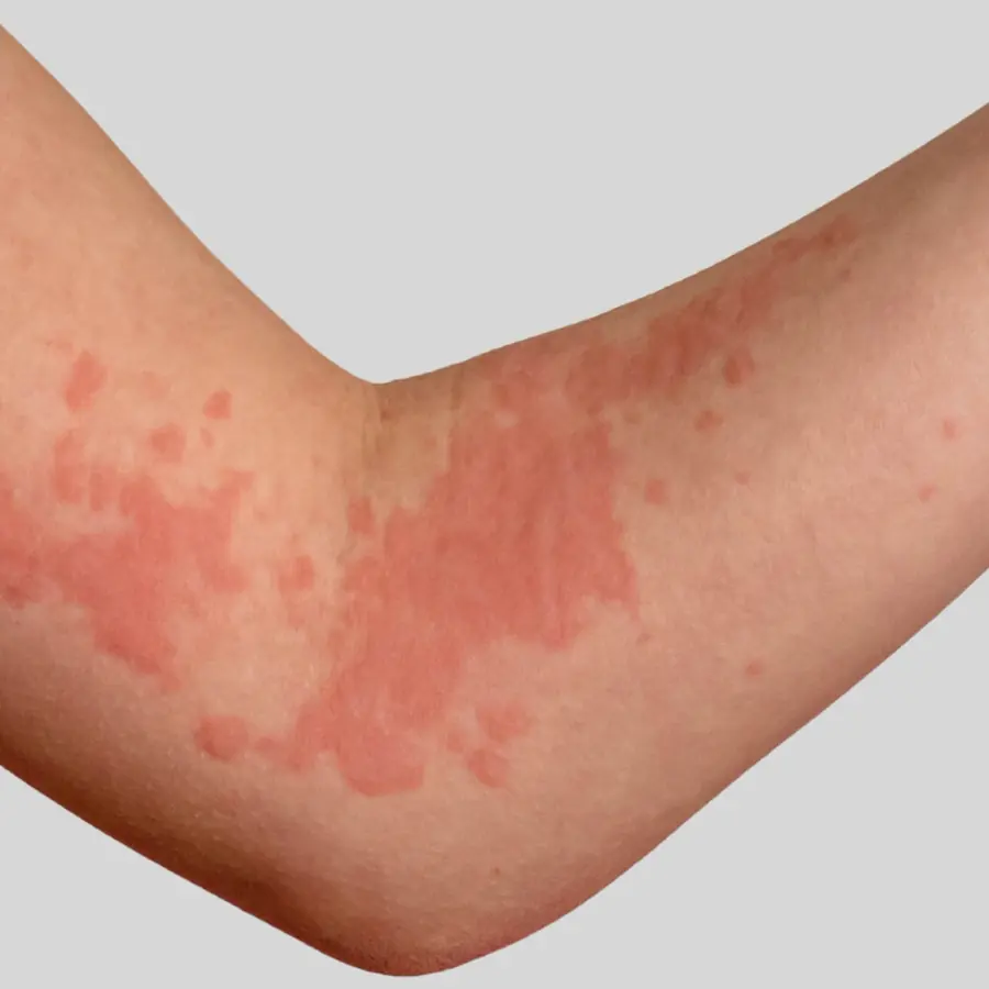 Urticaria