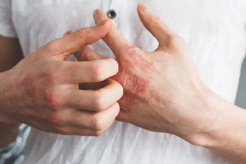 Lichen Planus
