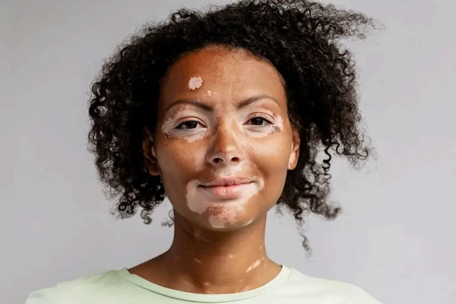 Vitiligo