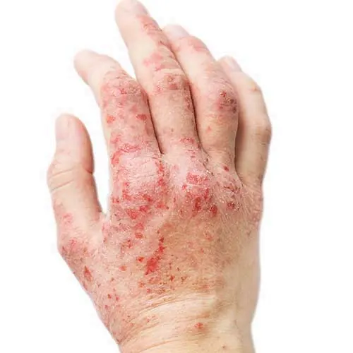 Eczema